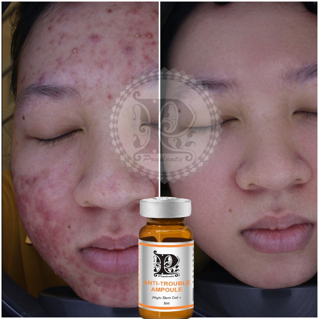 Serum Mụn Anti Trouble Ampoule [ MIBITI ] 5ml/Chai | BigBuy360 - bigbuy360.vn