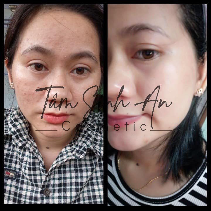 Serum Quét Sạch Mụn Thâm Rỗ 💖FREESHIP💖Serum EDORA - 3 Ngày Hiệu Quả Rõ Rệt - Tâm Sinh An Cosmetic - Mãi Mãi Tuổi 18 | BigBuy360 - bigbuy360.vn