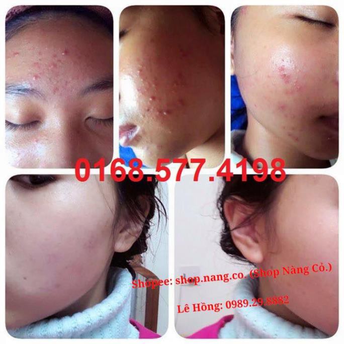 Kem Đông Y KEM MỤN Ngân Bình > Hết mụn thâm sẹo, mụn bọc mủ, mụn ẩn, mụn đầu đen > KEM XÓA MỤN ĐÔNG Y NGÂN BÌNH