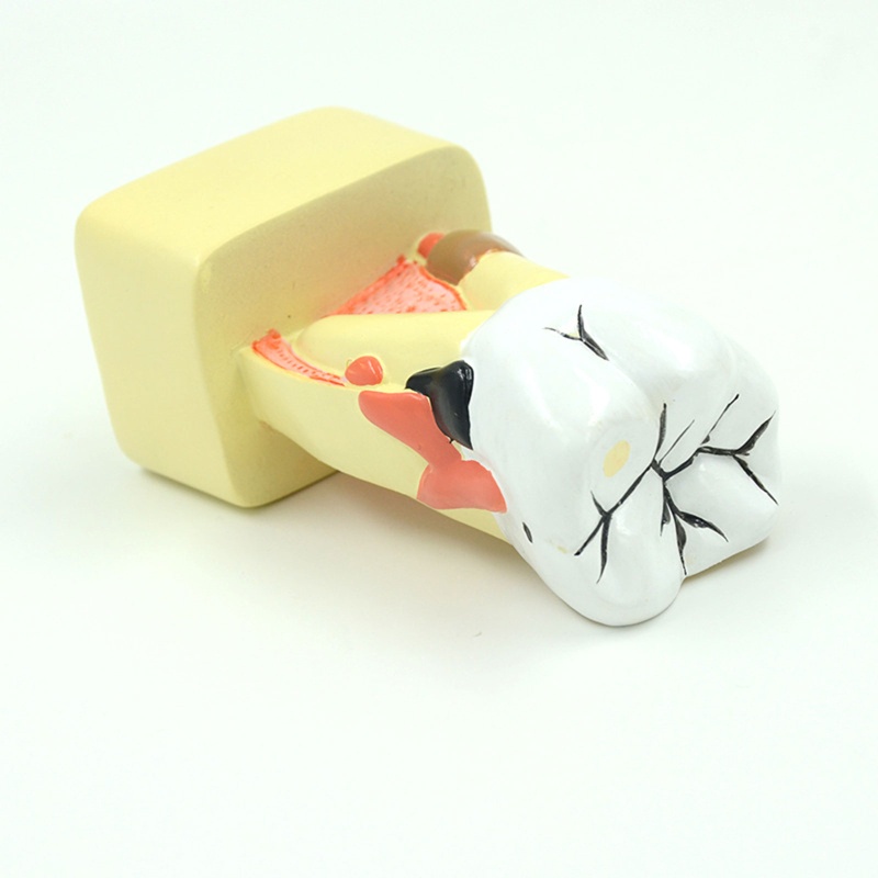 blg Dental Model Periodontal Disease Analysis for Dentist Teaching Dentistry Clinic