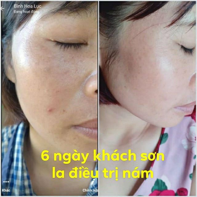 Kem Hút nám, tàn nhang ol cell