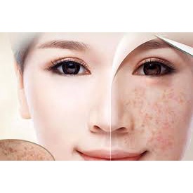 ⭐ CHUYÊN SỈ ⭐ 𝐇𝐔̃ 𝐊𝐄𝐌 𝐓𝐑𝐈̣ 𝐍𝐀́𝐌 𝐓𝐀̀𝐍 𝐍𝐇𝐀𝐍𝐆 , 𝐓𝐑𝐈̣ 𝐌𝐔̣𝐍 𝐓𝐇𝐀̂𝐌 𝐓𝐑𝐎̀𝐍 𝐁𝐀𝐍 Đ𝐄̂𝐌 𝐂𝐋𝐎𝐁𝐄𝐓𝐀𝐌𝐈𝐋 𝐆 𝐓𝐇𝐀́𝐈 𝐋𝐀𝐍