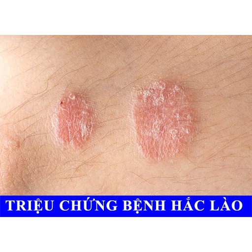  kem bôi ngứa, ghẻ, nấm da, viem da, hắc lào, á sừng, mề đay, tổ đỉa.. - Hàng có sẵn