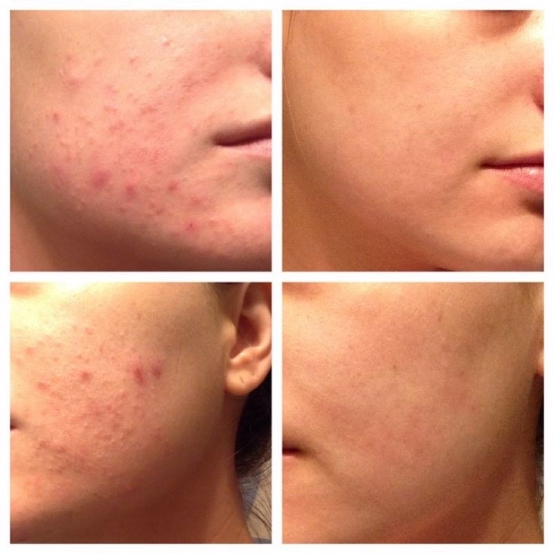 Tẩy da chết hóa học Alpha Hydrox AHA soufflé 12% Glycolic Aha | BigBuy360 - bigbuy360.vn