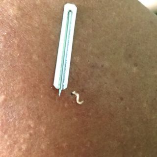 Kim nặn mụn tiệt trùng - Kim nặn mụn y tế