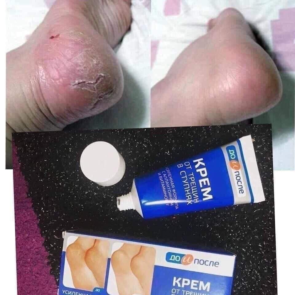 kem nẻ gót chân Kpem Foot Cream giảm nẻ chân nứt chân khô da chân dưỡng gót chân