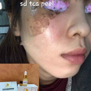 PEEL THAY DA MẶT TCA_USA