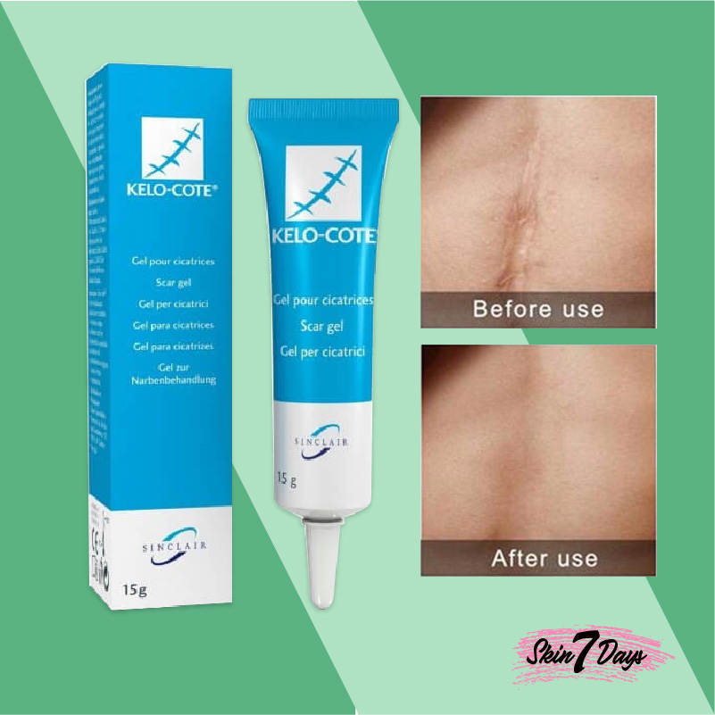 (Hàng Mới Về) Kem Dưỡng Da Kelo Cote 15g Hiệu Quả Cho Máy May Keloid