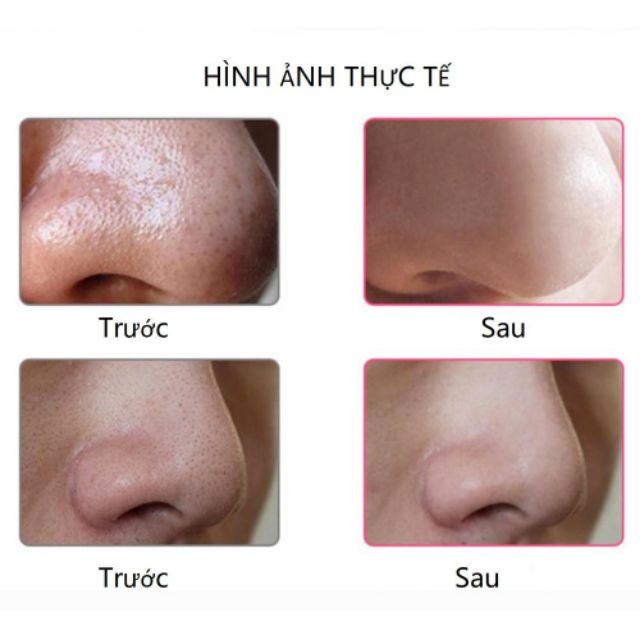 Máy hút mụn đầu đen