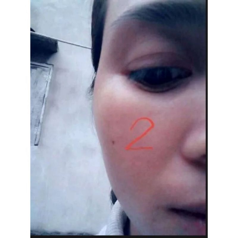 Tinh chất chấm nam ,tàn nhang ,sẹo rỗ Đức Thịnh