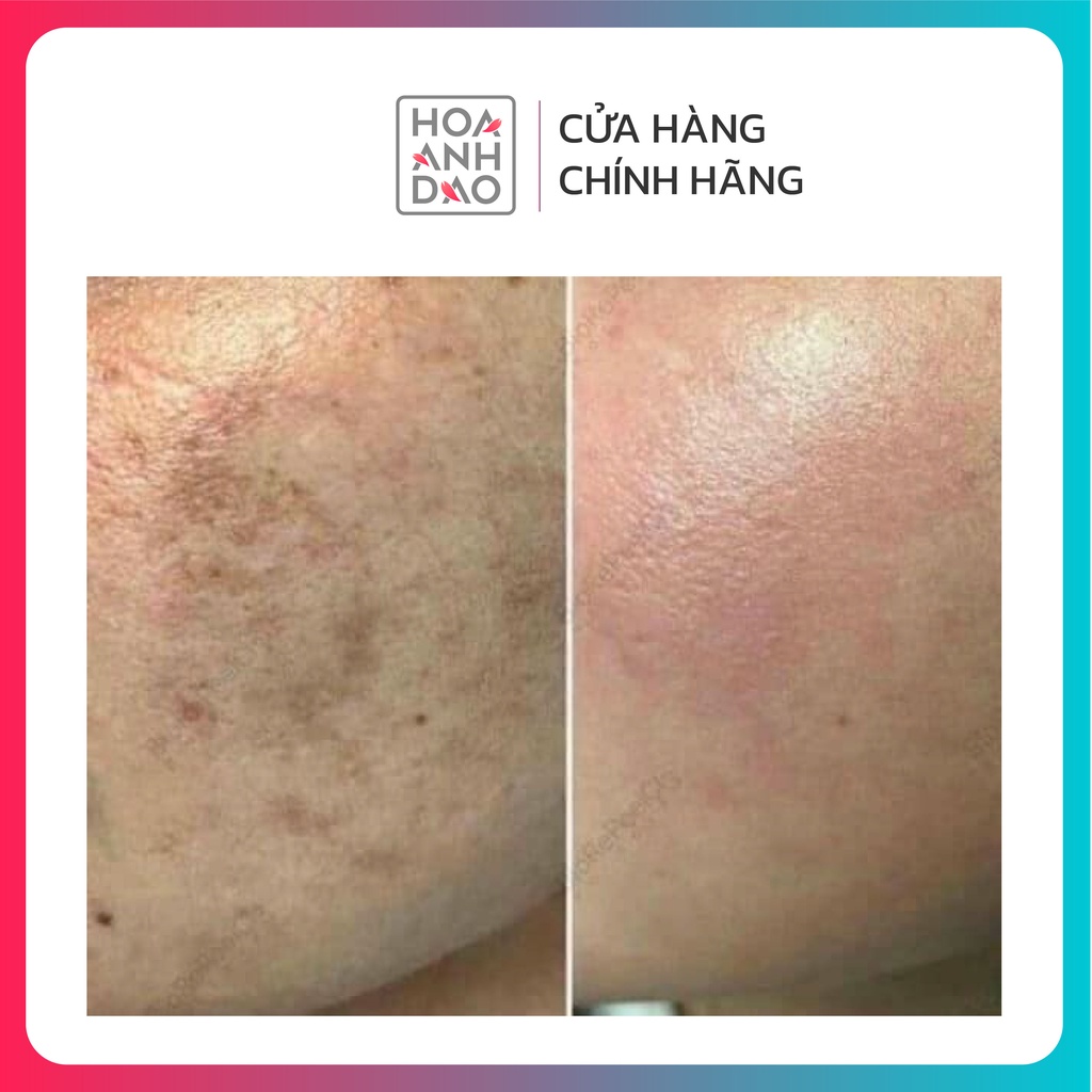 Kem giúp giảm nám Mesoestetic Cosmelan 2