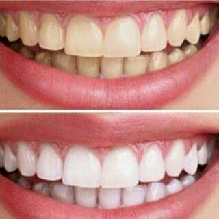 Bột tẩy trắng răng