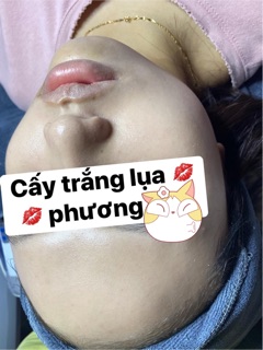 Cấy trắng spa handmade