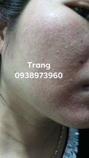 Combo Thuốc Bắc Tái Tạo Da Dưỡng Da
