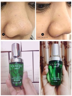 Ủ mụn youngerc ( hình thật trên)