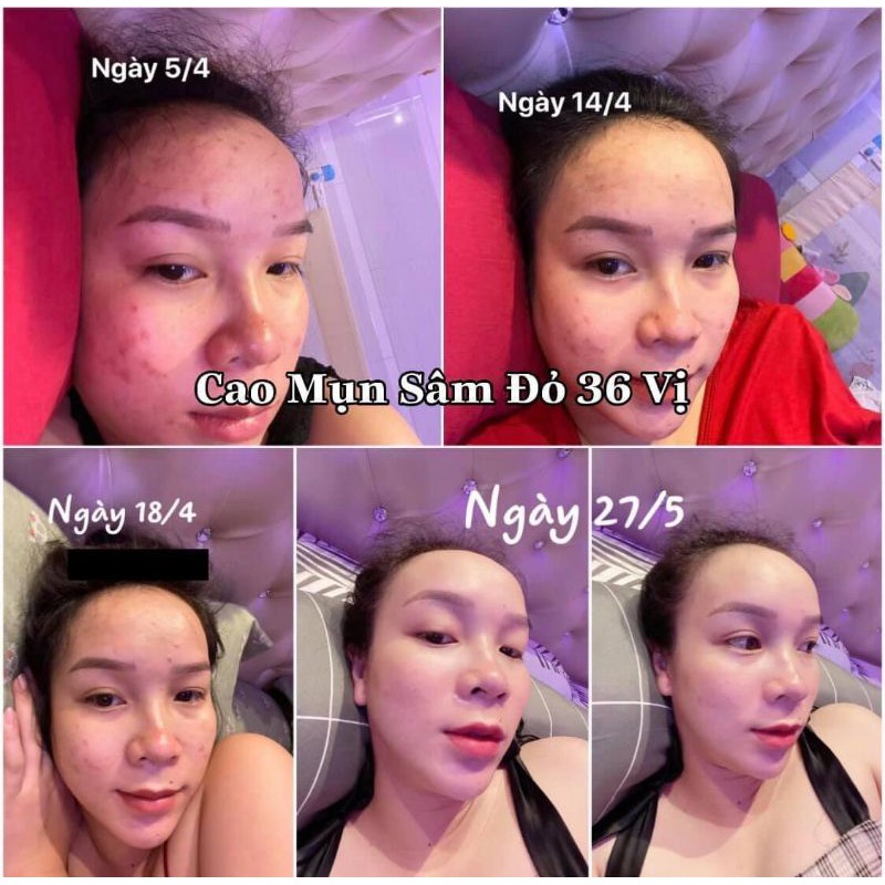 Kem dưỡng da mụn, Cao mụn sâm đỏ 36 vị chính hãng, giảm mụn, dưỡng trắng da, phục hồi da, chăm sóc da, Meea Organic | BigBuy360 - bigbuy360.vn