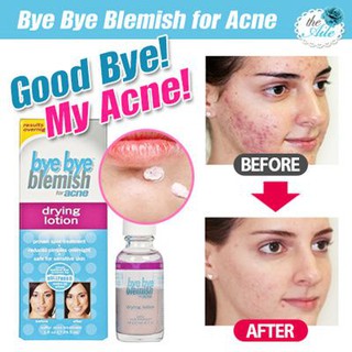 [Quinshop.vn] Lotion Làm Xẹp Mụn Sưng Cấp Tốc Bye Bye Blemish Drying Lotion