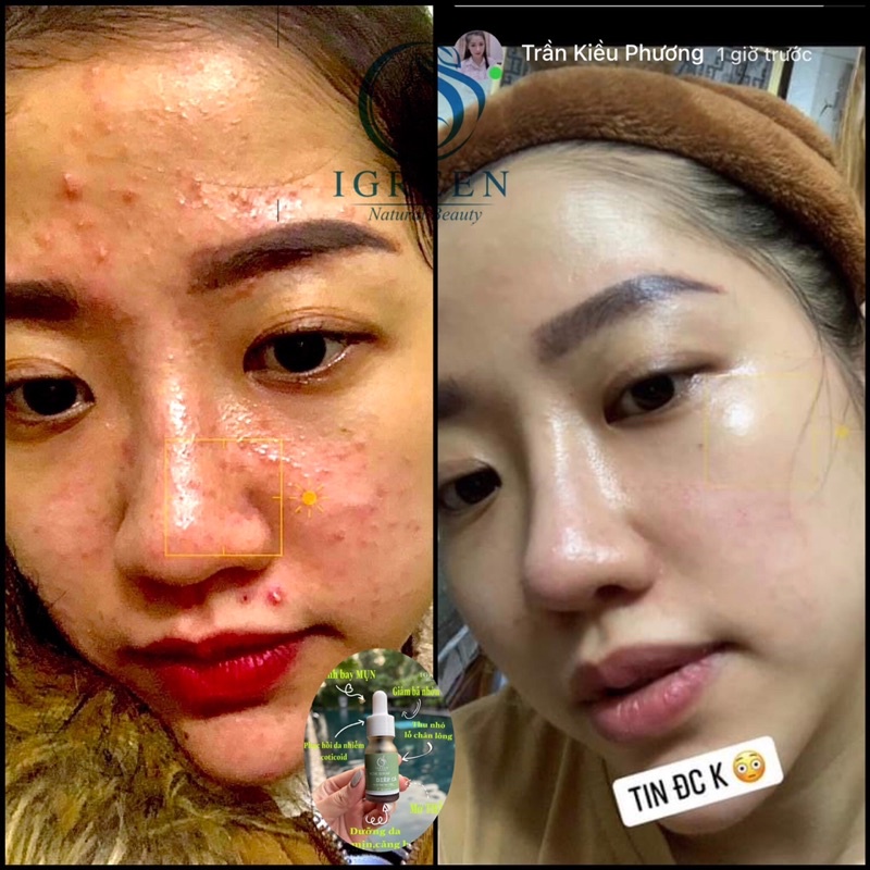 Serum Diếp Cá: - Sạch bay tất cả các loại mụn sau 7 ngày! - Sạch thâm, da sáng đều màu! - Kiềm dầu, se khít | BigBuy360 - bigbuy360.vn