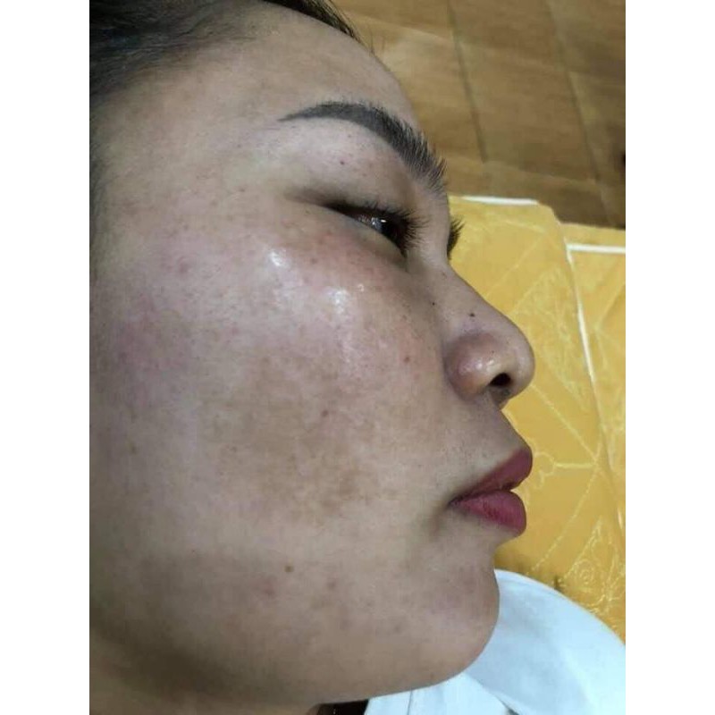 Bột Đánh Nám Tàn Nhang (gồm 2 bột và 1 lọ collagen đặc)