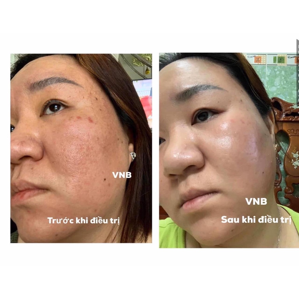 SERUM DẠNG PELL NHẸ VNB GINSENG PELL TREATMENT SERUM 30ML - 9293