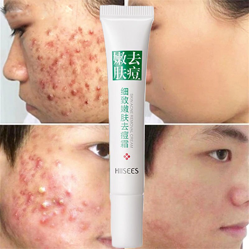 trị thâm mụn thuốc trị mụn ẩn thuốc trị mụn lưng Trị Mụn Hiệu Quả Tẩy Mụn Thảo Dược Các Điểm Kiểm Soát Dầu Kem Trị Mụn Dưỡng Da Làm Trắng Da Dưỡng Ẩm Mặt Loại Kem Chăm Sóc Da 20G