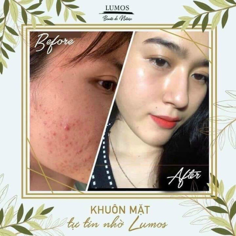 [Chính hãng+có tem] SERUM LUMOS ACNE XOÁ TAN NỖI LO THÂM MỤN | BigBuy360 - bigbuy360.vn