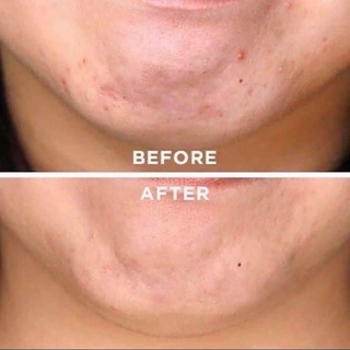 Serum tẩy da chết The Ordinary AHA 30% + BHA 2% Peeling Solution 30ml