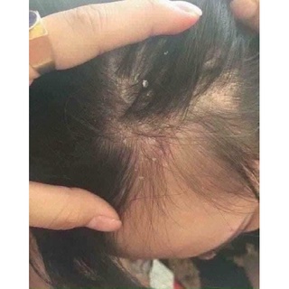 Dầu gội giảm gàu