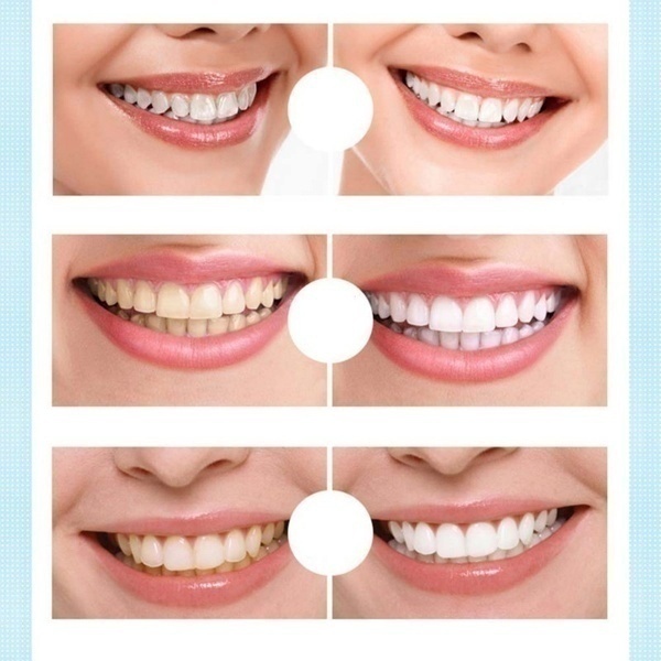 1 Bút Gel Làm Trắng Răng Loại Bỏ Vết Bẩn Làm Trắng Răng