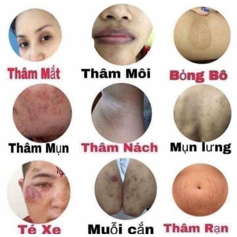 [Giảm giá 50k]Tinh chất mờ thâm minh khang bị móp vỏ hộp-  thâm mắt, môi, mụn, nách, bikini, tẩy trang - chỉ sau 14 ngày | BigBuy360 - bigbuy360.vn