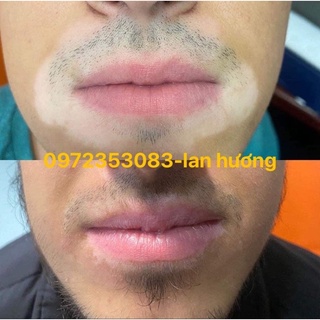 thảo dược bôi bạch biến