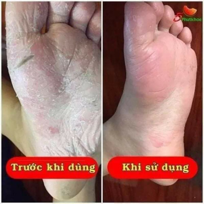 Kem Bôi Da Thảo Mộc LỢI AN,hết ngứa,vảy nến,á sừng,da tiếp xúc,da cơ địa,nước ăn chântay,hắc lào,chàm,nấm