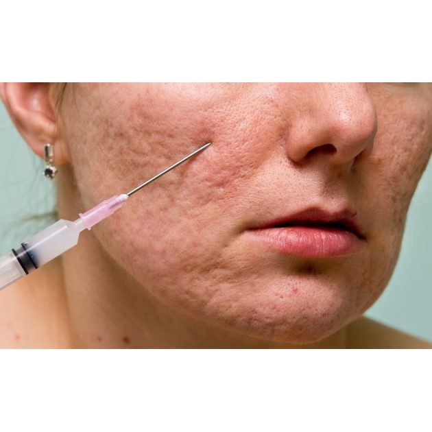 Kim Nokor 18G tách đáy sẹo rỗ có hướng dẫn với prp hàng nhập khẩu