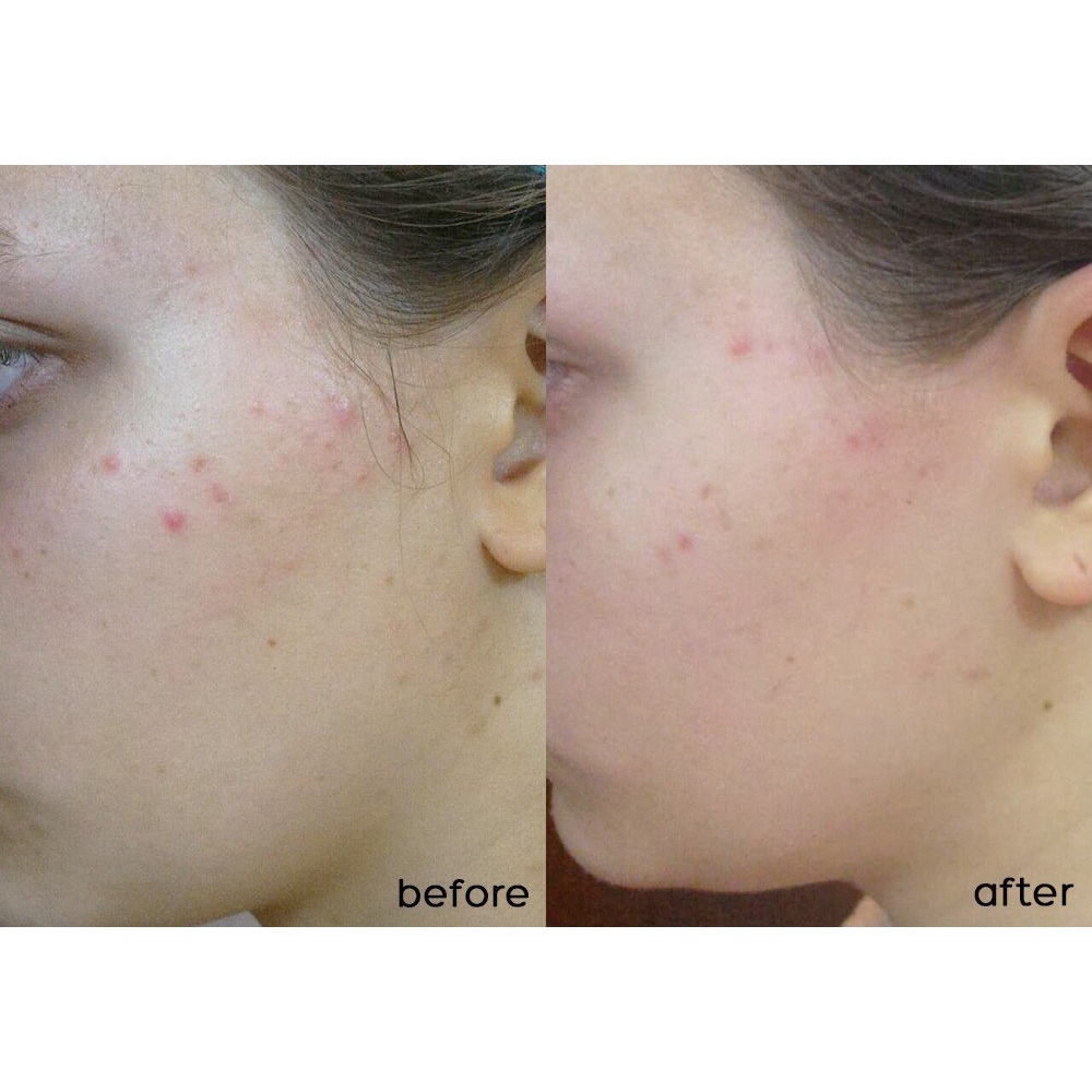 Gel Chấm Mụn Sưng Viêm SVR Sebiaclear Cicapeel Dành Cho Da Nhạy Cảm Dễ Mụn 15ML