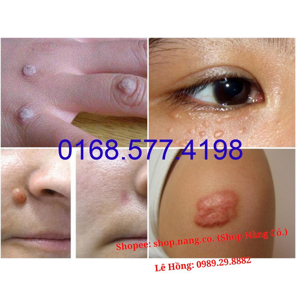 [Chính Hãng] Loại 3ml GEL TẨY NỐT RUỒI, MỤN CƠM, MỤN CÓC, SẸO LỒI, THỊT THỪA - Dvelinil nhập khẩu Nga Hiệu quả Tốt | BigBuy360 - bigbuy360.vn