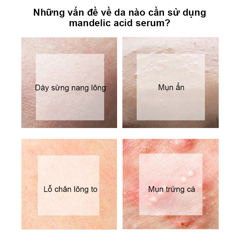 John Jeff Mandelic Acid 5% Huyết Thanh Dưỡng Da Mặt 30ml