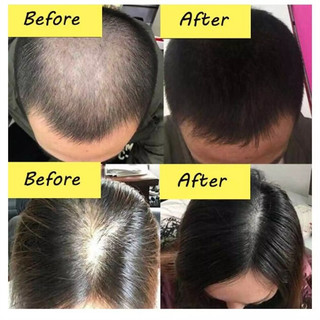 Tinh Chất Xịt Kích Thích Mọc Tóc Thành Phần EELHOE 20ml