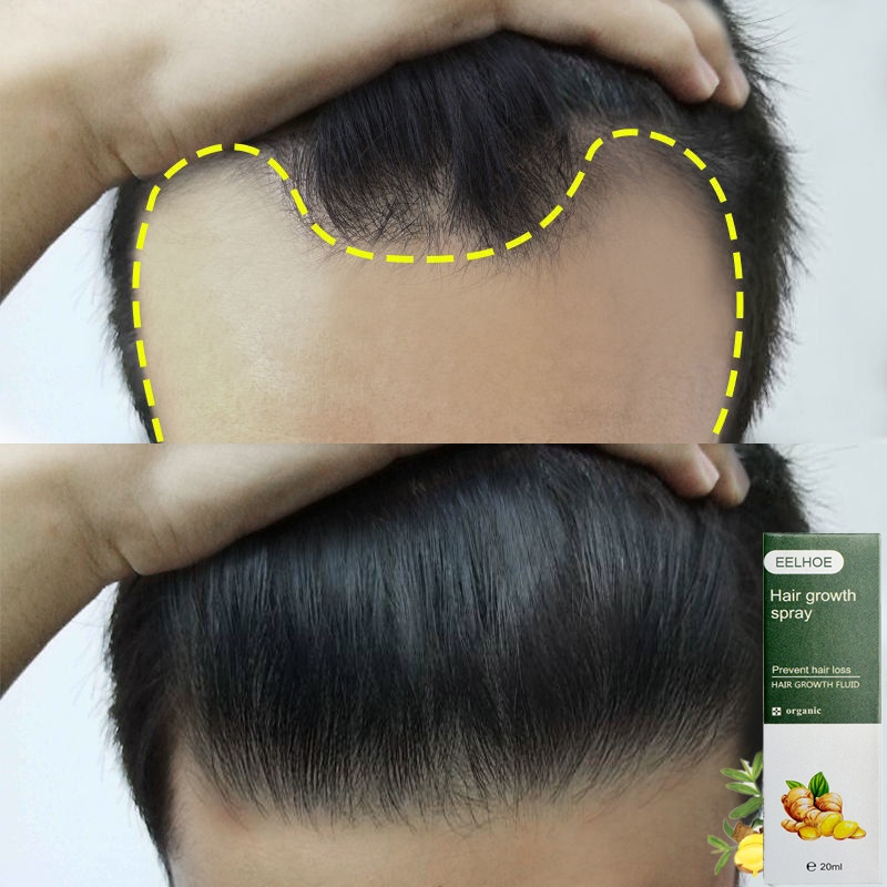 Tinh Chất Xịt Kích Thích Mọc Tóc Thành Phần EELHOE 20ml