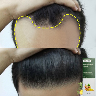 Tinh chất xịt kích thích mọc tóc thành phần eelhoe 20ml