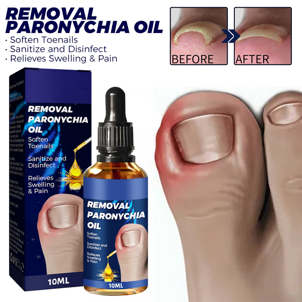 Tinh Dầu Paronychia 10ML Hỗ Trợ Giảm Bệnh Nấm Móng Và Móng Chân