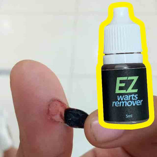 Ez warts Chính Hãng Loại Bỏ Mụn Thịt Dư Trên Da Nunal NOT Kasoy Oil warts, Phân Tử, Nunal, Kulugo, filiform, foot warts