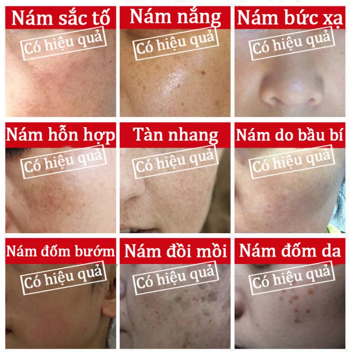 kem nám tàn nhang 50ML Serum trắng da và loại bỏ đốm nám tàn nhang Làm mờ vết thâm hiệu quả Chống lão hóa Làm trắng và sáng