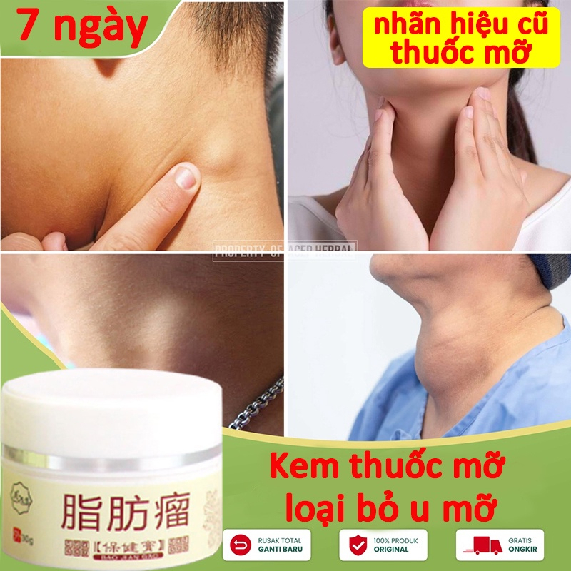 👍🏻Chính Hãng👍🏻 Kem tan mỡ chính hãng,Kem bôi u bướu mỡ,thuốc cục u thuốc lipoma của thuốc cục u ở cổ 30ml cho nhiều cục u dưới da đơn lẻ, u tuyến giáp, u mỡ dưới da dạng sợi