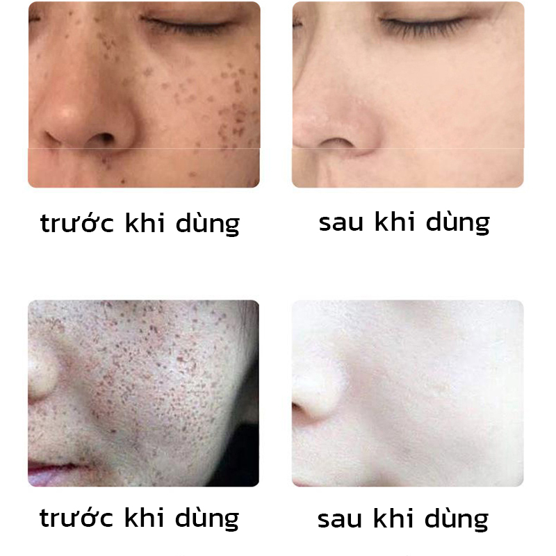 Tinh chất làm trắng sạch tàn nhang Serum thâm nám  Serum trắng da và xóa tàn nhang 30ml Hiệu quả làm mờ thâm nám tàn nhan, nám da，cháy nắng，làm trắng da mặt，Da Săn Chắc Mịn Màng Dưỡng