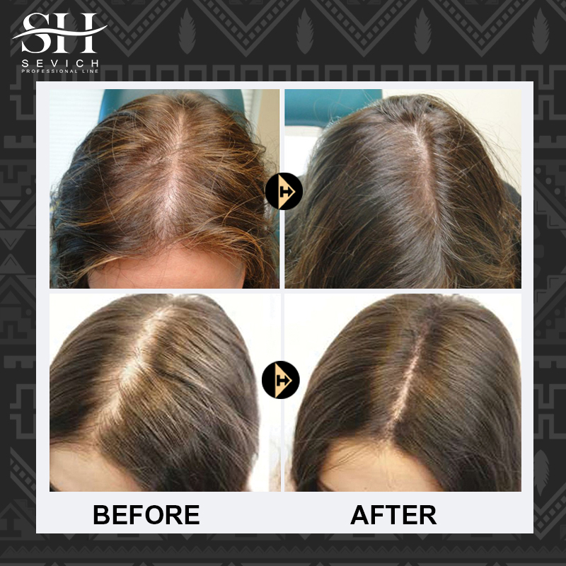 Xịt mọc tóc tế bào gốc Gạo SEVICH - Kích thích mọc tóc, ngăn rụng tóc  dưỡng ẩm và phục hồi tóc hư tổn 50ml