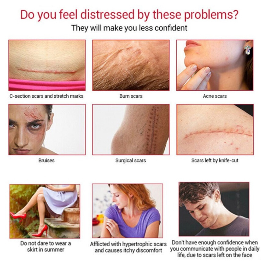 Kem Hỗ trợ giảm sẹo Và Vết Rạn Da Dermatix 15g