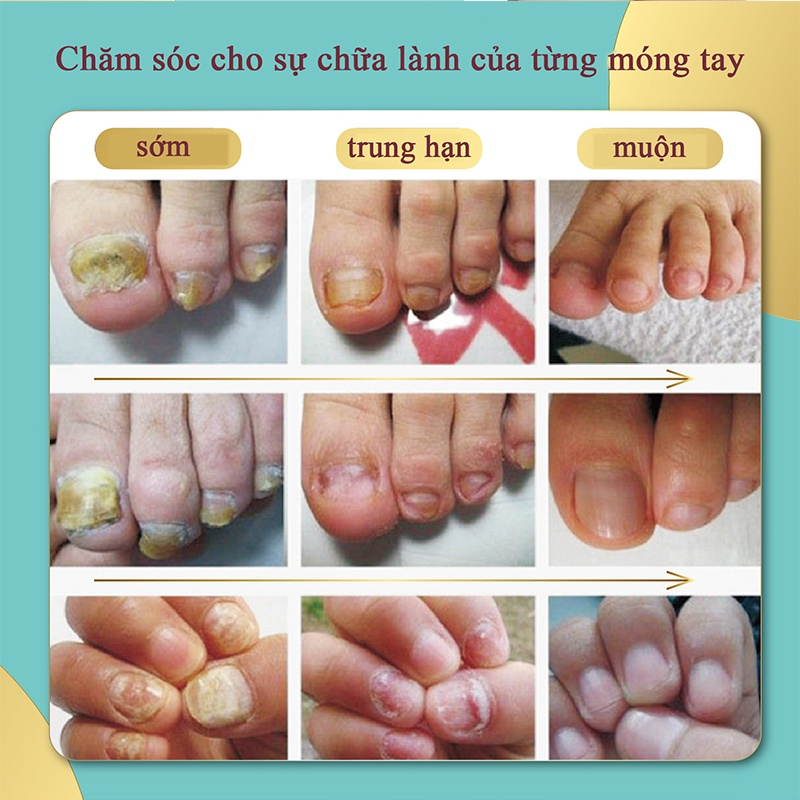 Kem nấm móng chân móng tay Nấm móng tay 15g Cải thiện vết nứt móng tay Kháng khuẩn Sửa chữa vết nứt móng tay