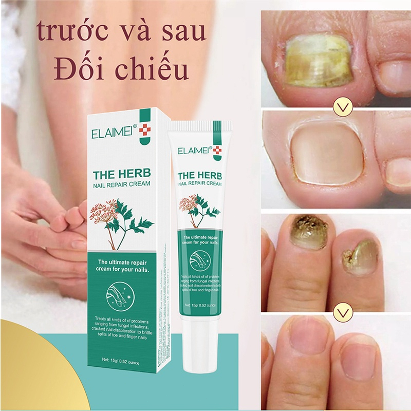 Kem nấm móng chân móng tay Nấm móng tay 15g Cải thiện vết nứt móng tay Kháng khuẩn Sửa chữa vết nứt móng tay