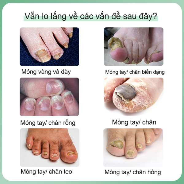 Kem nấm móng chân móng tay Nấm móng tay 15g Cải thiện vết nứt móng tay Kháng khuẩn Sửa chữa vết nứt móng tay
