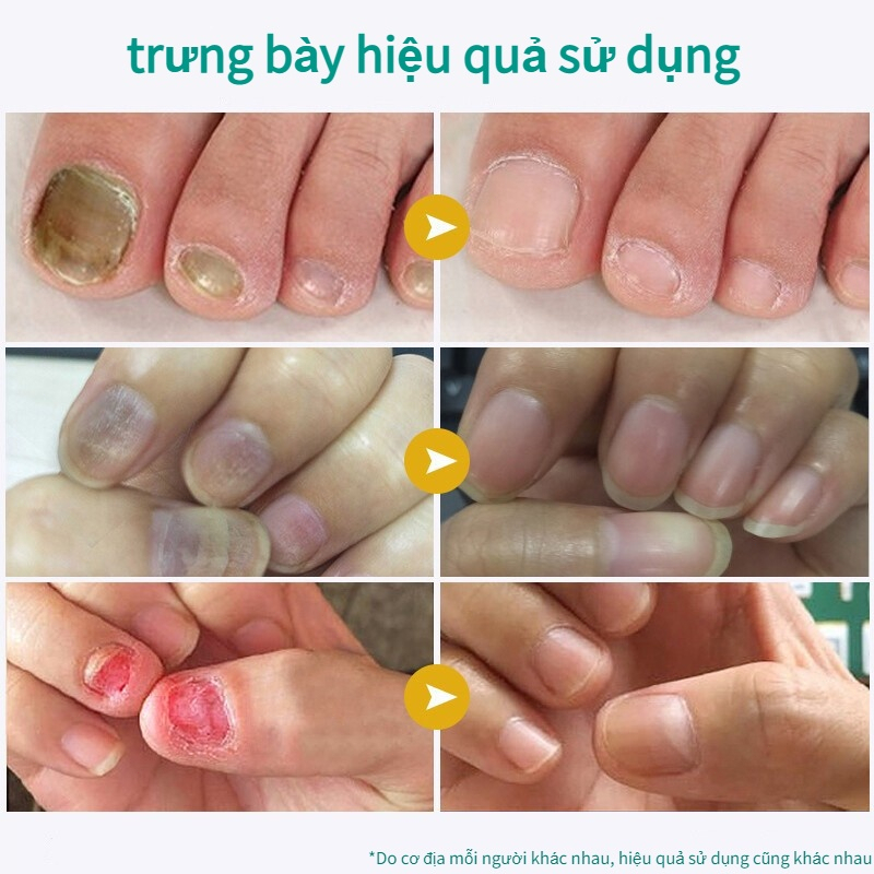 Kem nấm móng chân móng tay Nấm móng tay 15g Cải thiện vết nứt móng tay Kháng khuẩn Sửa chữa vết nứt móng tay